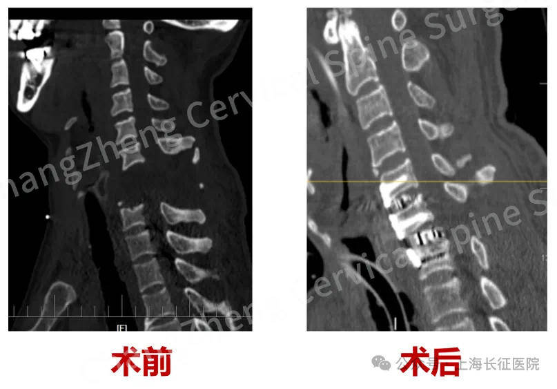 全球罕见！“身首离断”患者被救回 主刀医生：术毕两月整，已脱离呼吸机半月